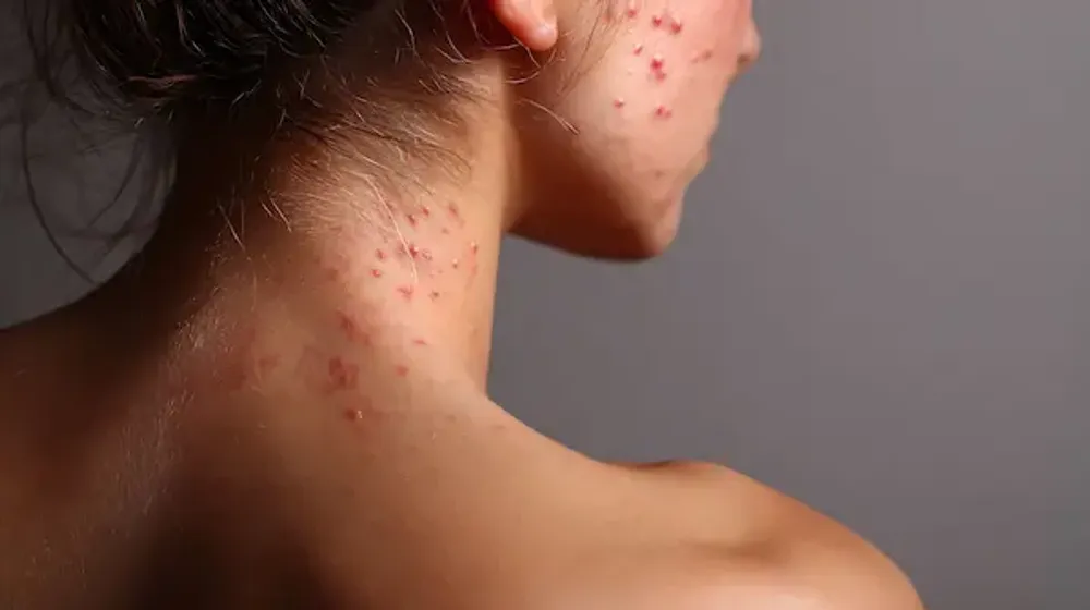 Acne Prevention